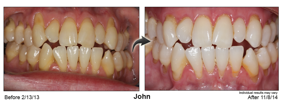 Rockwall Texas gum recession