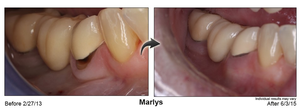 fix receding gums Rockwall Texas