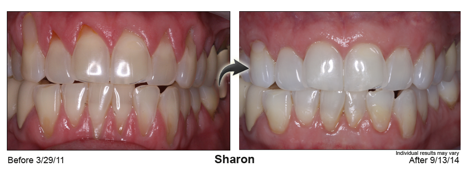 gum recession treatment Rockwall Texas